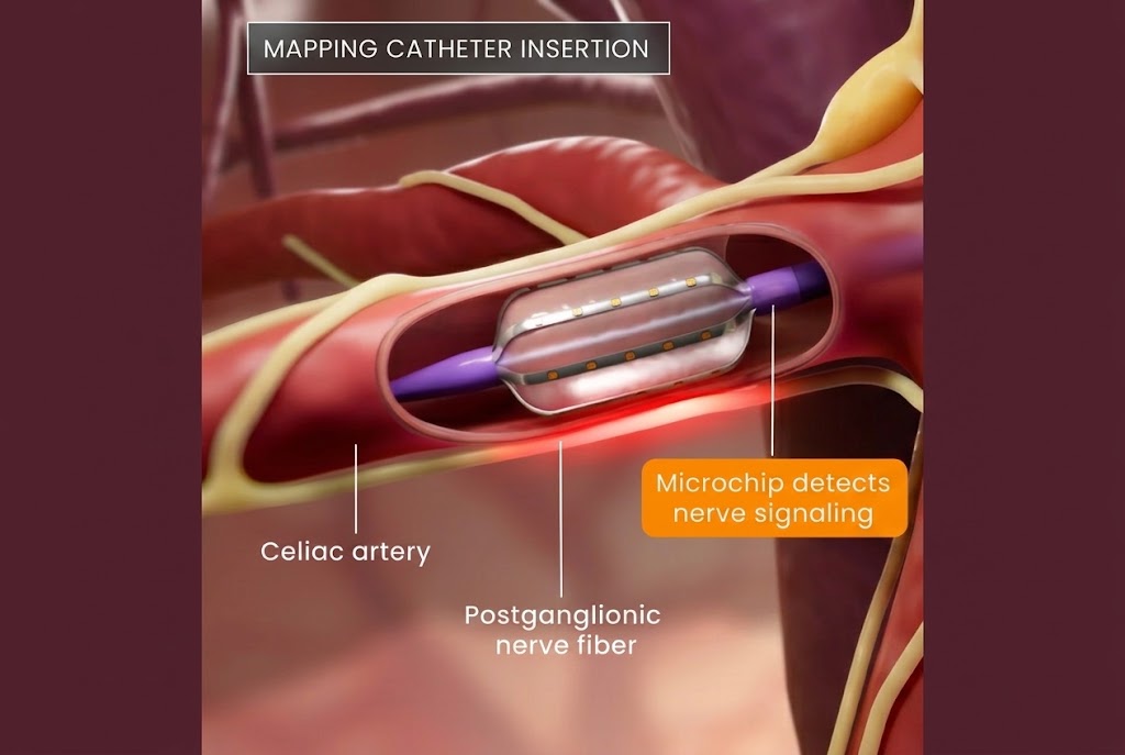 Autonomix catheter deployed in the celiac artery detecting postganglionic nerve signals via microchip, with a four-channel neural voltage waveform readout