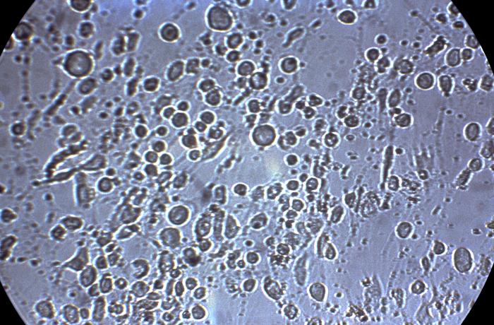 Herpes Simplex Virus